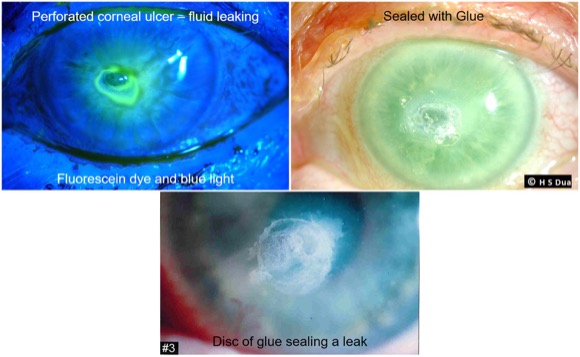 Eye surgeon in Nottingham. Corneal gluing – fibrin and cyanoacrylate. 1