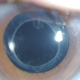 Refractive Lens Surgery