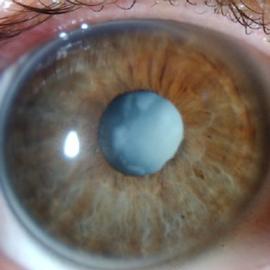 Image of an eye with cataract