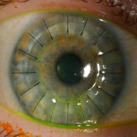 Diagram of the cornea