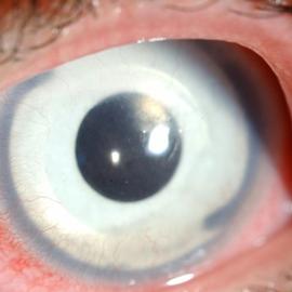 Pupiloplasty