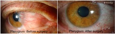 Conjunctiva issues. Excision of pinguecula and pterygium with autologous conjunctival graft. 1