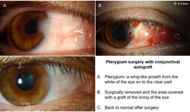 Conjunctiva issues. Excision of pinguecula and pterygium with autologous conjunctival graft. 2