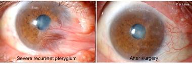 Conjunctiva issues. Excision of pinguecula and pterygium with autologous conjunctival graft. 3