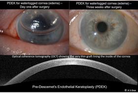 Eye doctor opthalmologist. Corneal transplants: full thickness and partial thickness. Tectonic grafts. 9