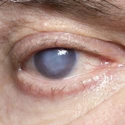 Glaucoma close up